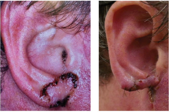 Figure 2. Final outcome after two further wide excisions and closure with skin graft