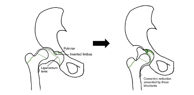 Figure 2. Intra-articular obstacles to concentric reduction of the hip in patients with developmental dysplasia of the hip