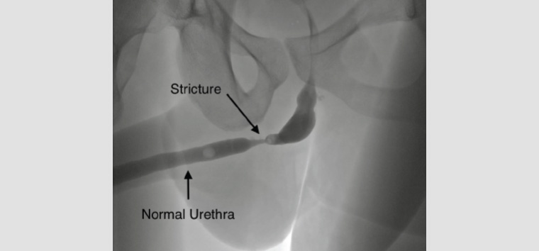 Figure 1. Voiding cystourethrogram displaying a bulbar urethral stricture with associated proximal dilatation