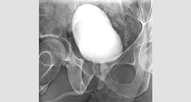 Figure 3. A retrograde urethrogram demonstrating a mid-distal bulbar stricture