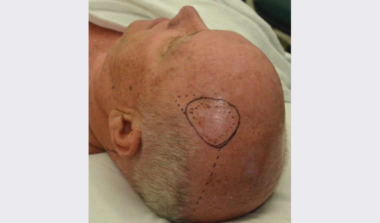 Figure 3. Pre-operative markings of large scalp intraepidermal carcinoma