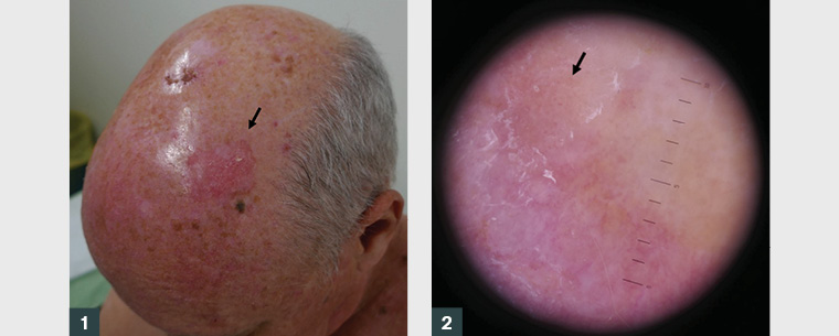 Figure 1. Large >5 cm intraepidermal carcinoma on the scalp (arrow). Figure 2. Pink scaly plaque of intraepidermal carcinoma with dermatoscopic features of linearly arranged ‘coiled’ vessels (arrow)