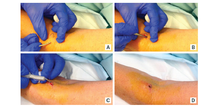 Figure 1. Curettage and cautery of a superficial basal cell carcinoma on the arm