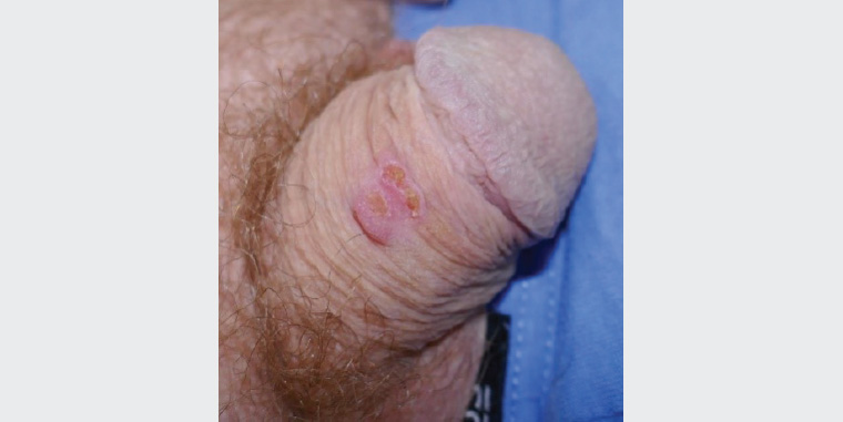 Figure 1. Dorsal penile lesion of a man aged 73 years