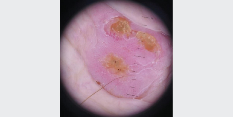 Figure 2. Dermoscopic image of the penile lesion