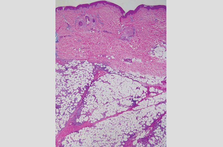 Figure 2. Microphotograph of the biopsy, showing a panniculitis that predominantly involves thickened septae with spilling of inflammatory cells into the fat lobules.
