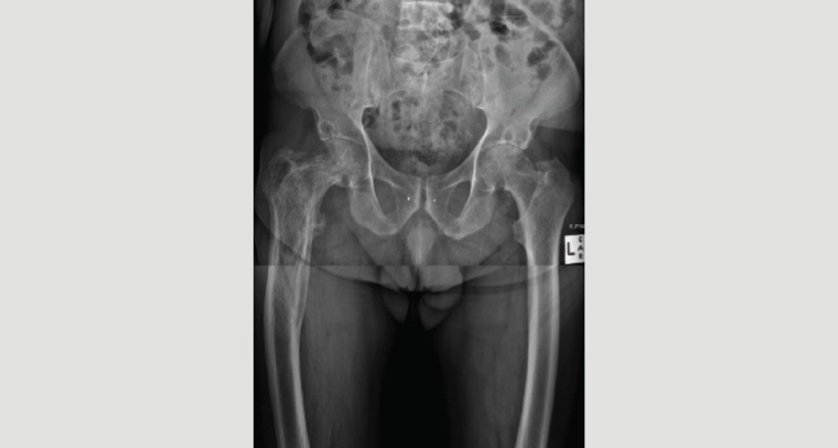 Figure 2. Plain X-ray of active Paget’s disease of bone in the right proximal femur of a man aged 75 years