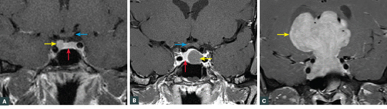 Figure 1. Magnetic resonance imaging of pituitary tumours