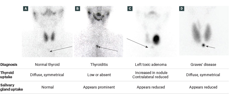 Figure 2. Anterior global views of Tc-99m pertechnetate thyroid scintigraphy