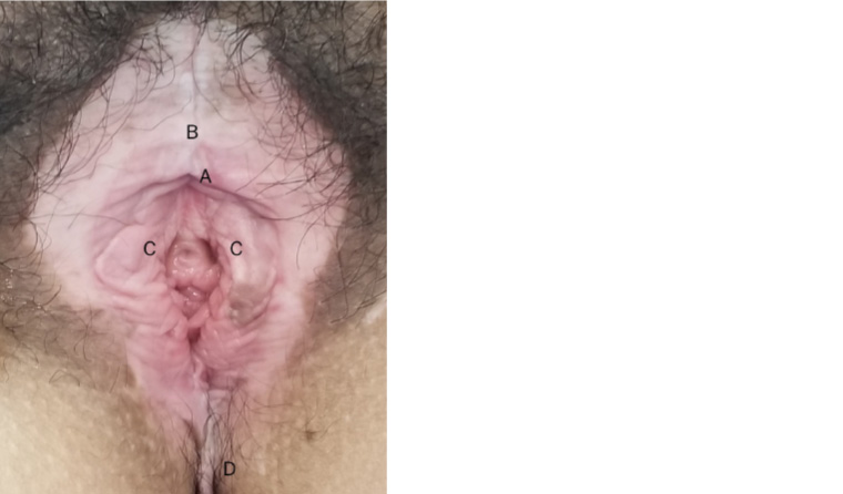Figure 1. Lichen sclerosus of vulva with some anatomical distortion