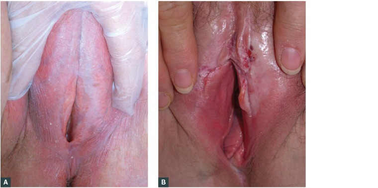 Figure 3. Various morphology of lichen sclerosus of the vulva (LSV)