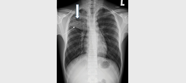 Figure 1. Chest radiograph from 2019 shows consolidation in the right upper lobe with cavitation within (thick arrow)