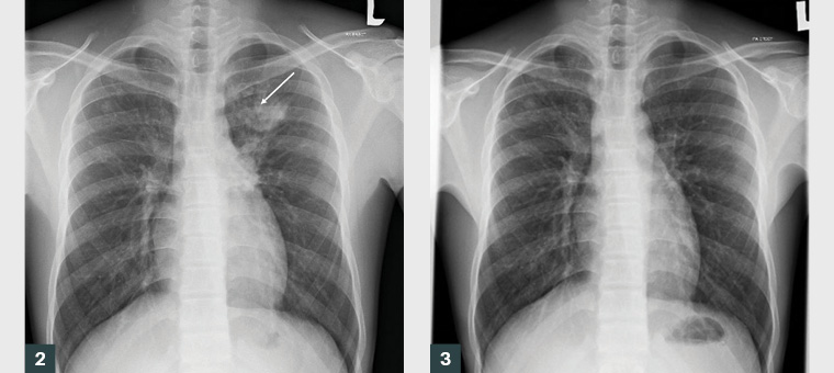 Figure 2. Chest radiograph from 2017 at initial diagnosis of pulmonary tuberculosis shows a focal area of consolidation (arrow) in the left upper zone.  Figure 3. Chest radiograph from 2018 shows complete resolution of the left upper lobe consolidation, with no residual changes following tuberculosis treatment.