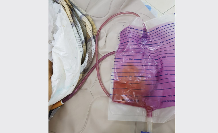 Figure 1. The yellowish urine is seen against the purple-stained urinary bag and tubing