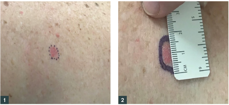 Figure 1. Basal cell carcinoma with outer edges of lesion marked with a Codman marker; Figure 2. Dots around the margin connected to form a continuous line, measured to have a diameter of 2–3 mm