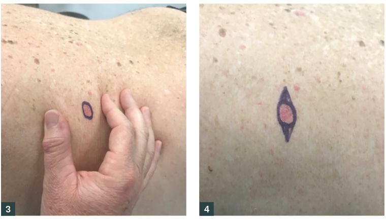 Figure 3. Skin placed under tension to determine the direction of closure; Figure 4. Ellipse drawn around the lesion for elliptical excision; the outer edge of the markings is the line of excision