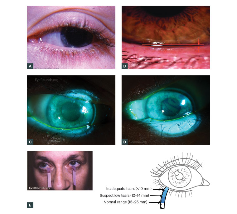 Figure 3. Images portraying information that can lead to a diagnosis of dry eye disease