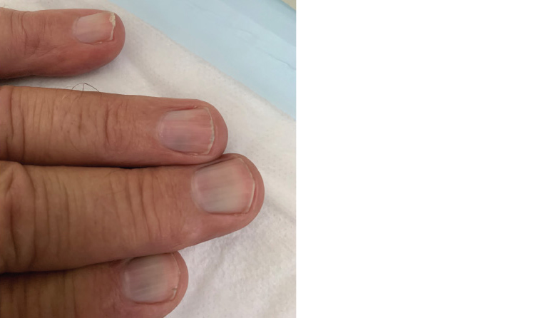 Figure 1. The patient’s fingernails