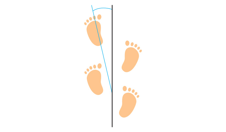 Figure 1. The foot progression angle is the angular difference between the axis of the foot and the line of progression