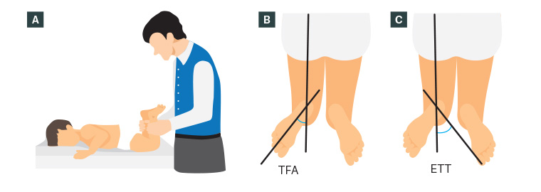 Figure 3. Measurement of tibial torsion