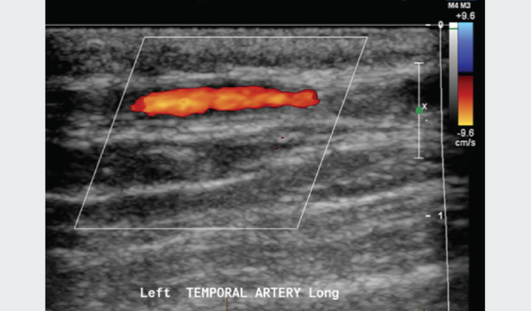 Figure 1. Normal ultrasound of the temporal arteries