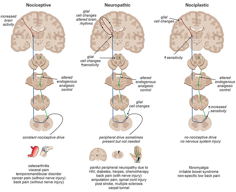 Figure 1. Chronic pain can be divided into three major categories: nociceptive, neuropathic and nociplastic.