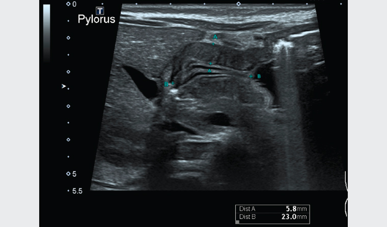 Figure 1. Abdominal ultrasound showing a pyloric muscular wall thickness of 5.7 mm (Distance A)