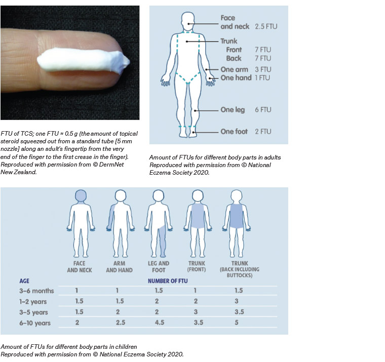 Figure 1. Fingertip units (FTUs) of topical corticosteroid (TCS) per application1,3,14,18