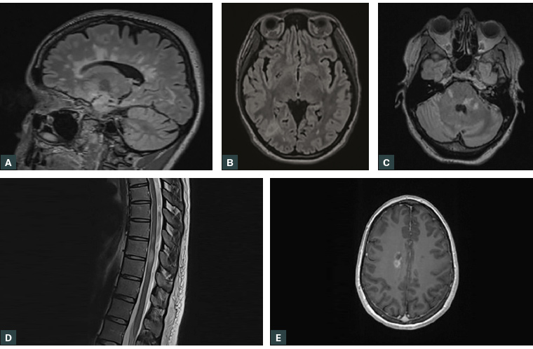 Figure 1. Typical multiple sclerosis magnetic resonance imaging findings, sourced from multiple patients A. Periventricular lesions (FLAIR sequence); B. Juxtacortical lesion in the right parieto-occipital region (FLAIR sequence); C. Brainstem and cerebellar lesions (FLAIR sequence); D. Spinal cord lesions in the thoracic cord (T2-weighted turbo spin echo sequence); E. Gadolinium-enhancing lesion (T1-weighted sequence)