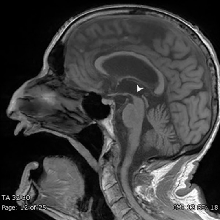 Figure 1. T1-weighted sagittal view magnetic resonance imaging showing midbrain atrophy, also known as the Hummingbird sign