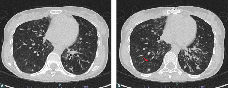 Axial computed tomography scan of the chest demonstrating dilated airways on bilateral lobes of the lungs.