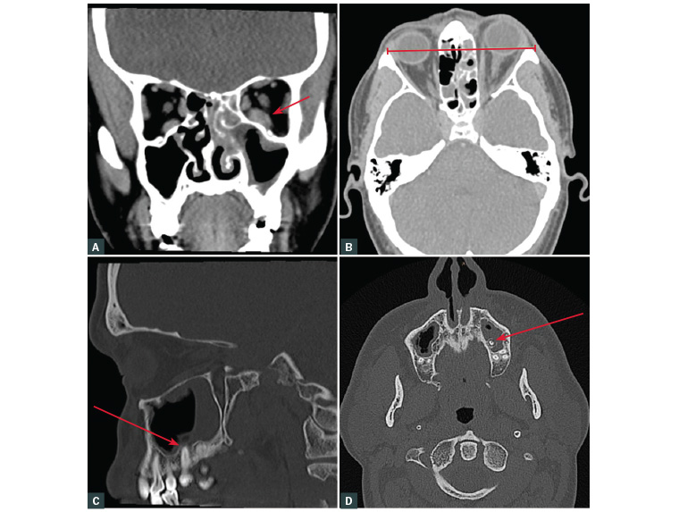 Figure 2. Computed tomography images with arrows highlighting the following features A. Enlarged left inferior rectus muscle (coronal view); B. Left proptosis (axial view); C. & D. Tooth within left maxillary sinus with consequent sinusitis (sagittal and axial views)
