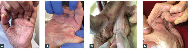 Figure 1. Examples of spastic hand with complications successfully treated