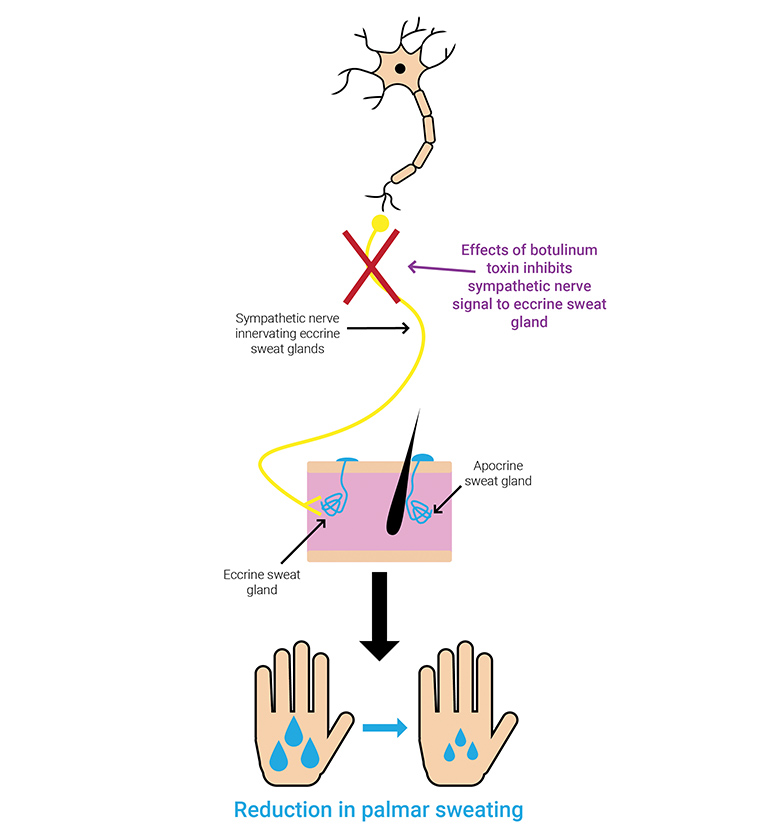 Figure 2. Mechanism of botulinum toxin A injection in relieving palmar hyperhidrosis: the toxin inhibits the sympathetic nerve signal to eccrine sweat glands.
