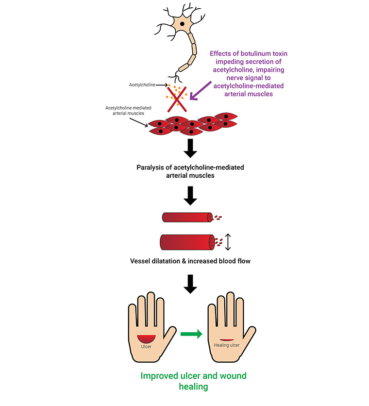 Figure 3. Mechanism of botulinum toxin A in improving circulation: inhibition of sympathetic adrenergic or cholinergic vasoconstriction, inhibition of sensory nerves and/or endothelial exocytosis of endothelin 1, and inhibition of pain that causes vasodilatation, helping to heal the ulcerations.