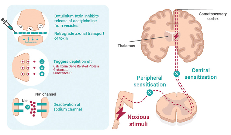 Figure 4. Mechanism of botulinum toxin A injection in pain reduction involves 1) retrograde axonal transport of toxin, 2) inhibition of neuropeptides such as substance P, calcitonin gene-related protein and glutamate and 3) deactivation of sodium channels. These mechanisms of action reduce peripheral and central sensitisation.