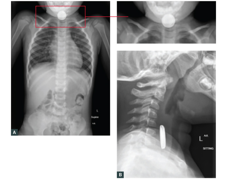 Figure 3. X-ray imaging antero-posterior and lateral views mouth to anus