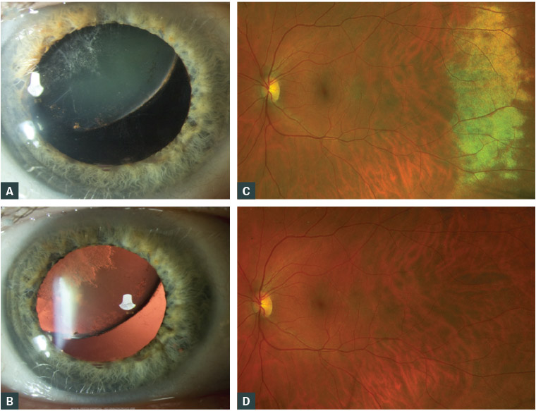 RACGP Eye injuries