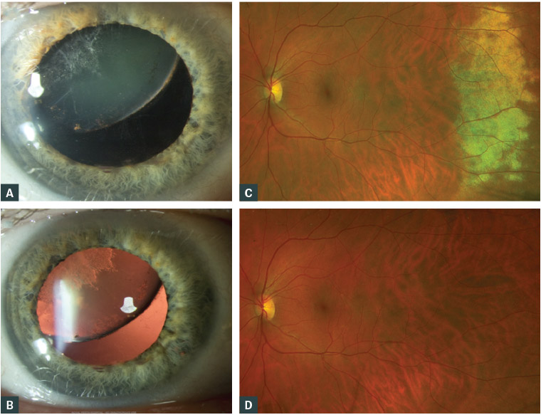 Figure 2. Closed globe injury from contusion includes lens dislocation [A, B] and commotio retinae [C, D].