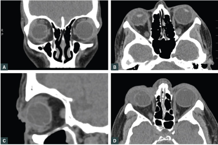 Figure 3. Open globe injury diagnosed on radiological signs