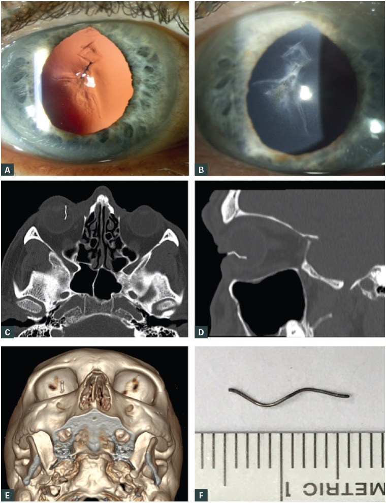 Figure 4. Penetrating intraocular injuries diagnosed on clinical and radiological signs
