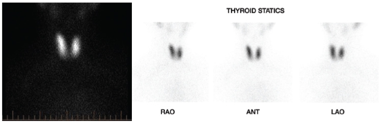 Figure 1. Radionuclide thyroid scan demonstrating a very mildly enlarged thyroid with fairly uniform tracer uptake throughout, consistent with Graves’ disease