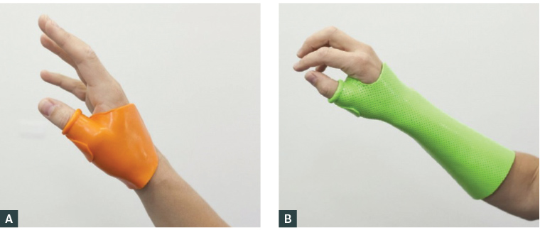 Figure 1. Custom orthoses fabricated by hand therapists