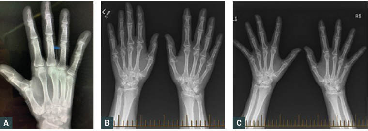 Figure 3. Radiographs of two patients with basal thumb osteoarthritis