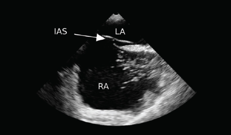 Figure 2. Transoesophageal echocardiography short-axis view prior to filling by agitated saline IAS, interatrial septum; LA, left atrium; RA, right atrium