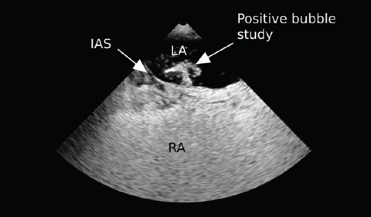 Figure 3. Transoesophageal echocardiography short-axis view after filling by agitated saline, demonstrating positive right-to-left shunt (white arrow labelled ‘Positive bubble study’) IAS, interatrial septum; LA, left atrium; RA, right atrium