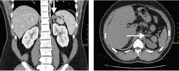 Figure 1. Adrenal computed tomography demonstrating a left adrenal adenoma (arrows)
