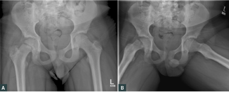 Figure 1. A. Antero-posterior pelvis X-ray; B. Frog-leg lateral X-ray