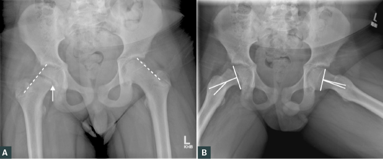 Figure 2. A. Antero-posterior pelvis X-ray demonstrating abnormal Klein’s line (dotted line) and widening of the physis on the right hip (solid arrow); B. Frog-leg lateral X-ray demonstrating an increased the Southwick slip angle (solid line)
