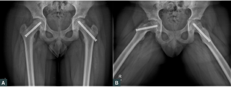 Figure 3. A. Antero-posterior pelvis X-ray; B. Frog-leg lateral X-ray demonstrating in situ fixation of the right slipped upper femoral epiphysis and prophylactic pinning of the left hip